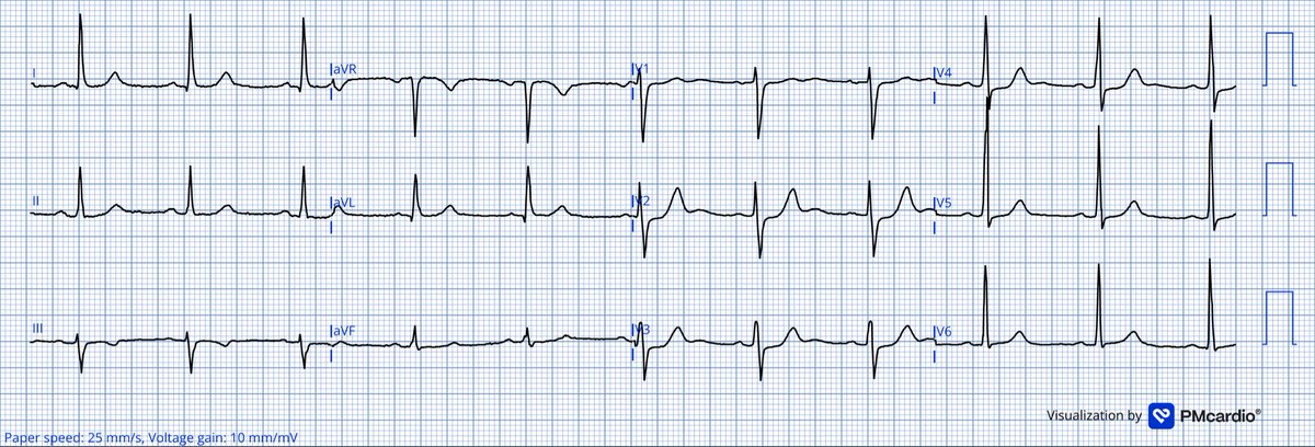 TheECGMedic's tweet image. Spot Diagnosis Challenge!

#ECG #ECGChallenge