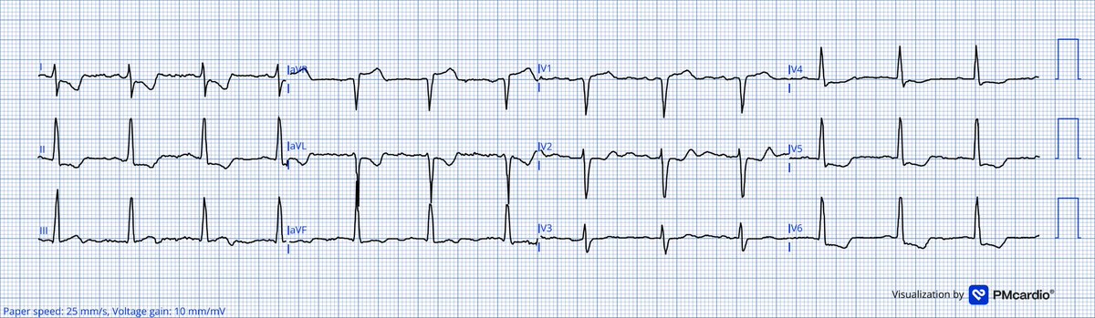 TheECGMedic's tweet image. Spot Diagnosis Challenge!

#ECG #ECGChallenge