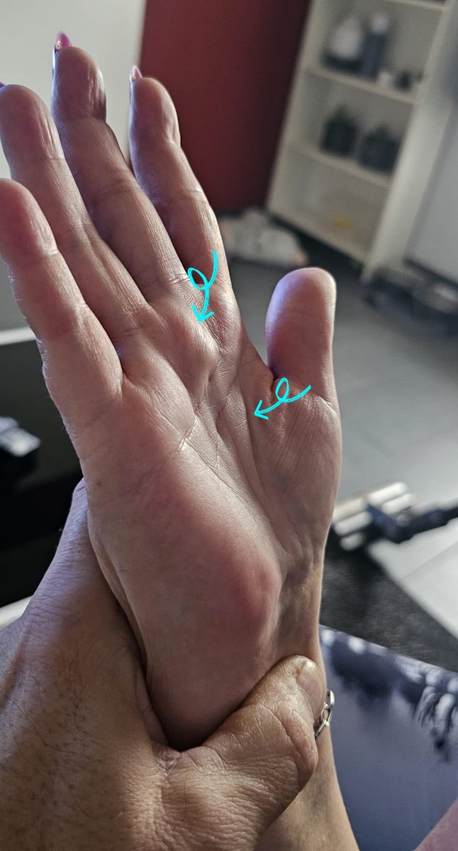↝𝓓𝓲𝓽𝓪 ↜ (@ditkadoditka) on Twitter photo Dělají se mi v dlani boule. Nebolí, ale při pohybu ruky, ztuhlý pocit.
Mám revmatoidní artritidu 4 stupeň.
Jde s tím něco dělat?
#dotaz #doktoři Dělají se mi v dlani boule. Nebolí, ale při pohybu ruky, ztuhlý pocit.
Mám revmatoidní artritidu 4 stupeň.
Jde s tím něco dělat?
#dotaz #doktoři