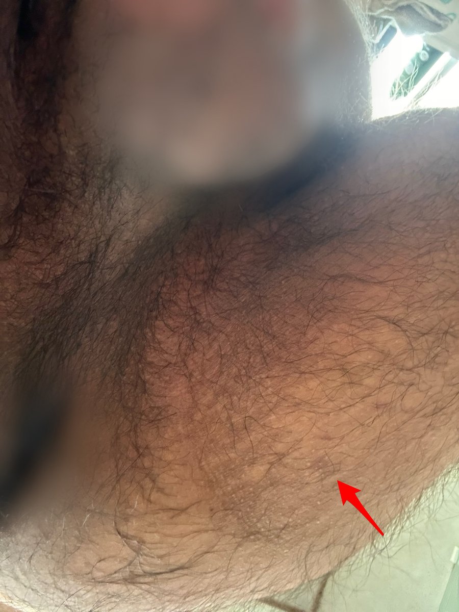 経過は良くないがとりあえず😇
今度はパンツ穿いてないけど🤣