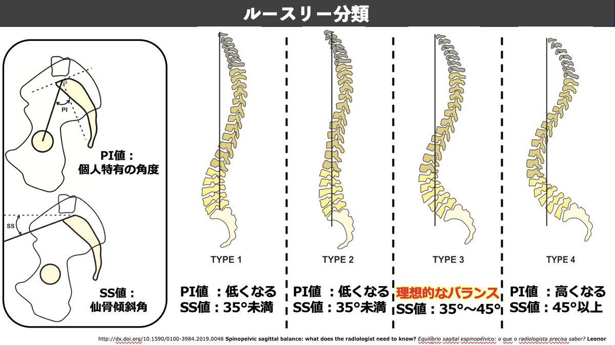 ✓ルースリー分類🔥 アライメントを把握する上で 【絶対】 確認するのは下図の分類 PI値は個人特有の角度であり変化する量はわずか  前弯、後弯、理想Typeのどれなのか見極めるようにしています！ GBC https://t.co/BAxa7A1PjB セミナー  https://t.co/vEdQ3WaxD8 インスタ ...
