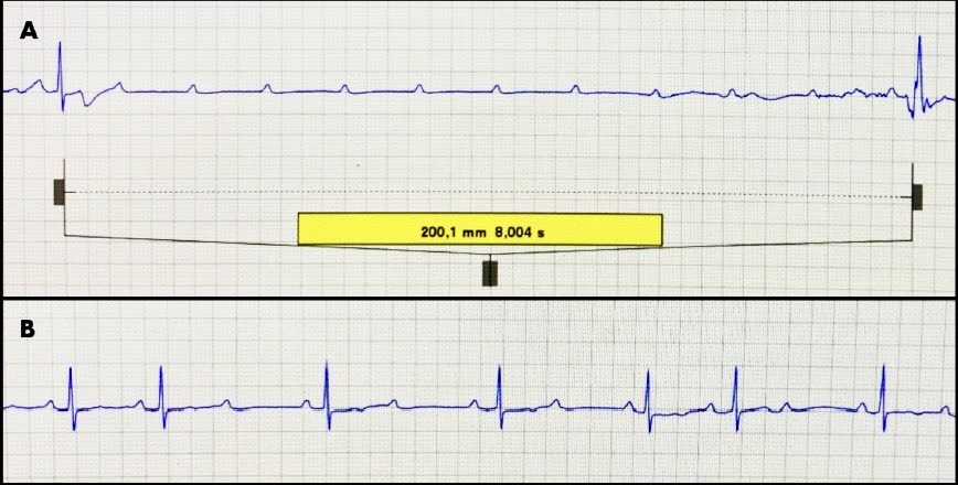 📍 Bloqueo auriculoventricular completo inducido por somatostatina. 

Complicación iatrogénica poco frecuente pero muy relevante. Estrechar vigilancia 🔍🔍

pubmed.ncbi.nlm.nih.gov/40997363/

<a href="/MedClinBarc/">Medicina Clínica</a> <a href="/JoseA_fdez12/">José A. Fernández Sánchez</a>