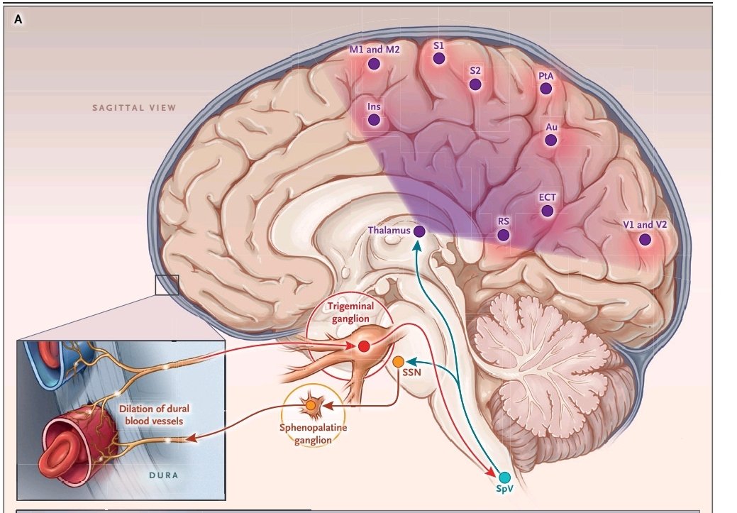 ChocogatoRacing's tweet photo. La migraña en imagen, siempre excelentes las imágenes del NEJM https://t.co/0d8vUDgfXH