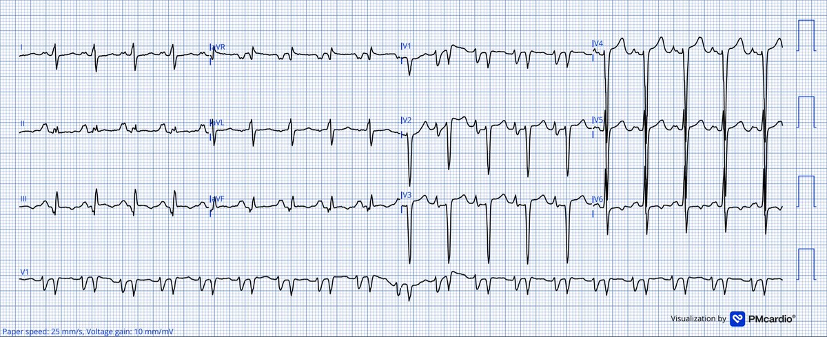 TheECGMedic's tweet image. 30M presents to ED with SOB for 4hrs.

What can you see on the ECG? 
What differentials could explain this ECG?

#ECG #ECGChallenge
