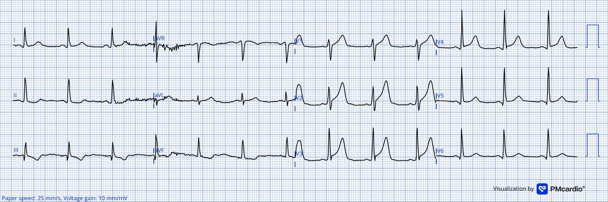 TheECGMedic's tweet image. Spot Diagnosis Challenge!

Is this normal variant STE?

#ECG #ECGChallenge