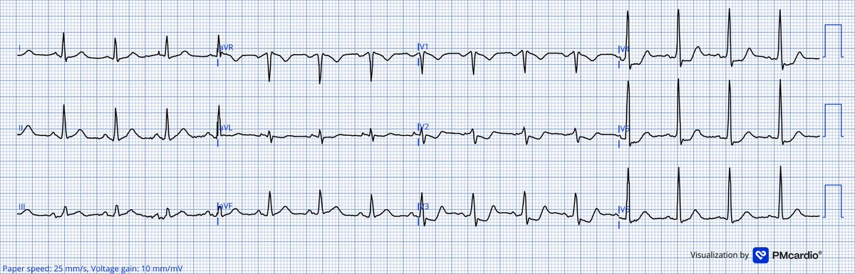 TheECGMedic's tweet image. Easy one!

#ECG #ECGChallenge