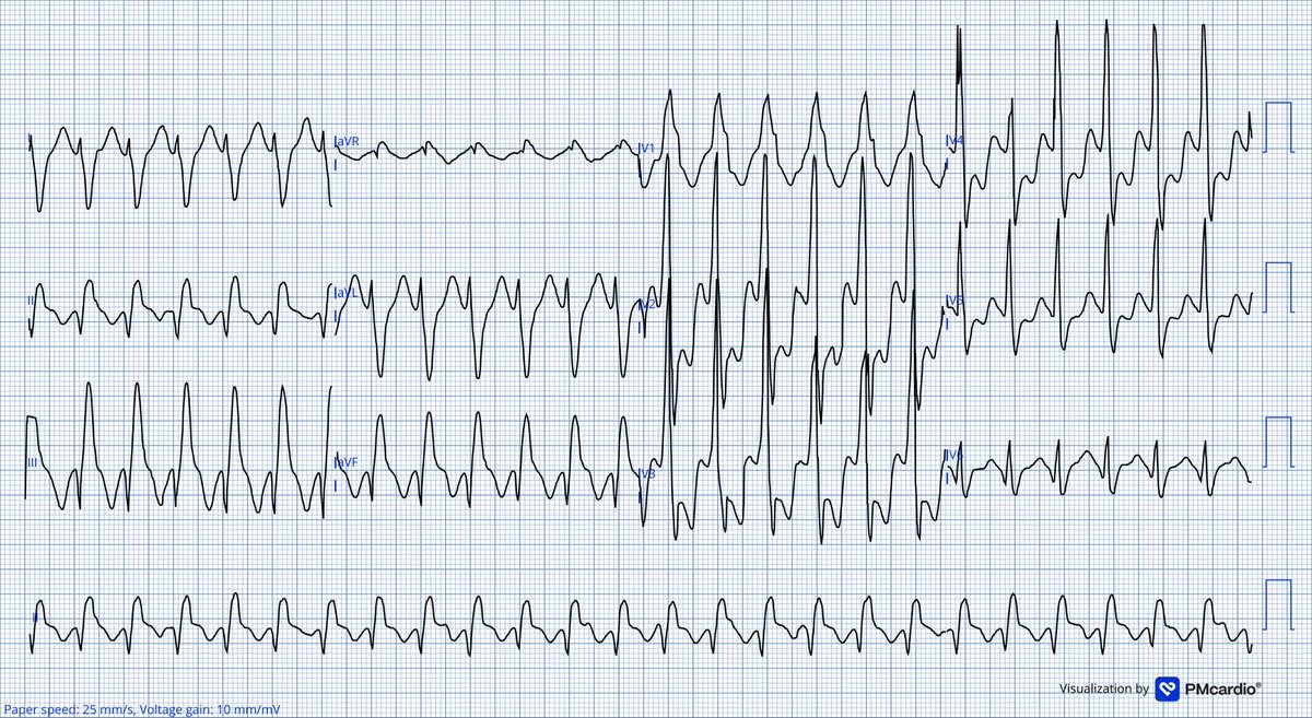 TheECGMedic's tweet image. What’s the rhythm?
Can you work out the possible cause?

Original ECG below

#ECG #ECGChallenge