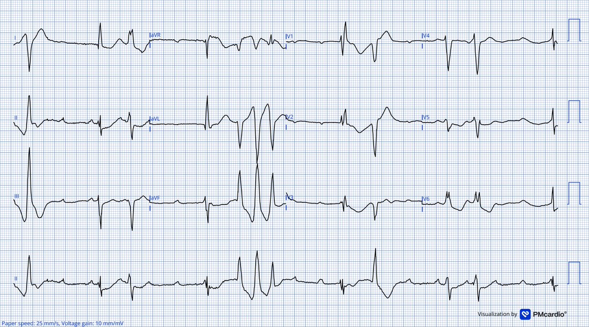 TheECGMedic's tweet image. Lots to dissect here! What do you see?

72F presents with syncope and palpitations. She is bradycardic and hypotensive. 

Very dangerous ECG!

#ECG #ECGChallenge