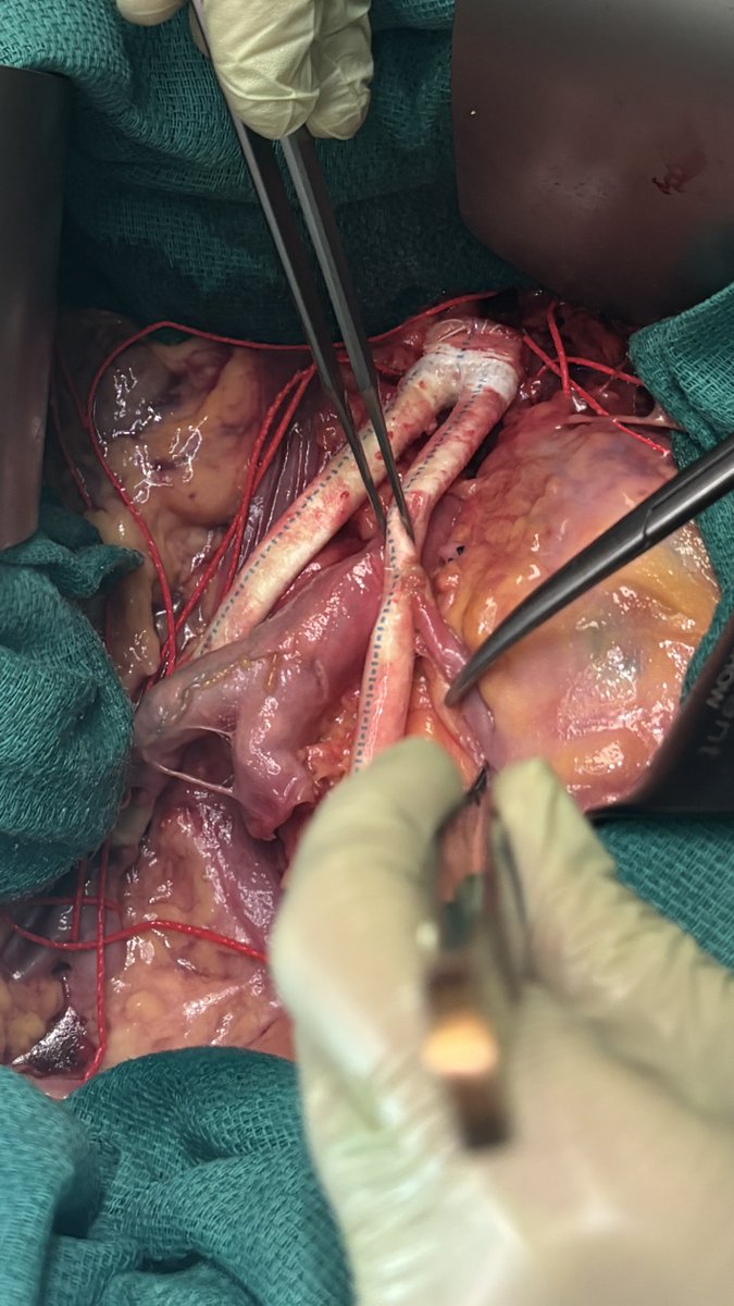 AlanLumsdenMD's tweet photo. Nicely reimplanted IMA at Open Aortic Course.  Join us next year . @DeBakeyCVedu https://t.co/Di17uTQH3r
