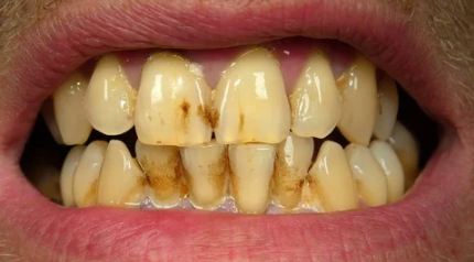 drdrumi's tweet photo. 🦷The tar in tobacco can severely stain teeth, forming "smoke stains." Only cleaning or whitening can remove them. 🚬🦷#dentalcare #protectteeth #popularscience https://t.co/WXPKpzSj8M