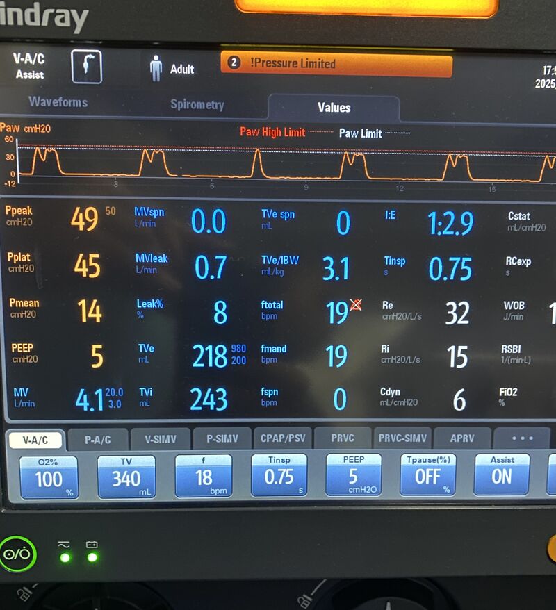 Ariel J Garnero (@arielg_rrt) on Twitter photo What is the TAG of the mode? How does this mode work? The vent is a Mindray and the mode is V-A/C. <a href="/ventilacionmeca/">Fede Gordo-Vidal</a> <a href="/DocMusician/">Doc Musician</a>   <a href="/emireles_c/">Eduardo Mireles-Cabodevila</a> <a href="/CCF_PCCM/">CCF Pulmonary and Critical Care Fellows</a> <a href="/DrMiguelIbarra1/">Dr. Miguel Ibarra-Estrada</a> <a href="/critconcepts/">Critical Concepts</a> <a href="/IM_Crit_/">IMCrit</a> <a href="/Vent_Busters/">VentBusters</a> <a href="/OfVentilation/">Society of Mechanical Ventilation</a> <a href="/ATC_Ventilator/">Ben Fabry</a>   <a href="/SaudiRTs/">Saudi Respiratory</a> <a href="/DrSateeshPCCM/">Sateesh chandra</a> What is the TAG of the mode? How does this mode work? The vent is a Mindray and the mode is V-A/C. <a href="/ventilacionmeca/">Fede Gordo-Vidal</a> <a href="/DocMusician/">Doc Musician</a>   <a href="/emireles_c/">Eduardo Mireles-Cabodevila</a> <a href="/CCF_PCCM/">CCF Pulmonary and Critical Care Fellows</a> <a href="/DrMiguelIbarra1/">Dr. Miguel Ibarra-Estrada</a> <a href="/critconcepts/">Critical Concepts</a> <a href="/IM_Crit_/">IMCrit</a> <a href="/Vent_Busters/">VentBusters</a> <a href="/OfVentilation/">Society of Mechanical Ventilation</a> <a href="/ATC_Ventilator/">Ben Fabry</a>   <a href="/SaudiRTs/">Saudi Respiratory</a> <a href="/DrSateeshPCCM/">Sateesh chandra</a>