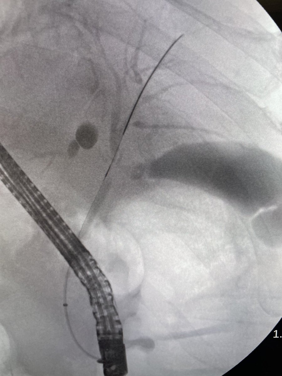 DouglasAdlerMD's tweet image. Suspected cholangiocarcinoma with cholecystitis. Two biliary stents placed across the hilum, one double pigtail stent placed into the gallbladder. #gitwitter #surgery