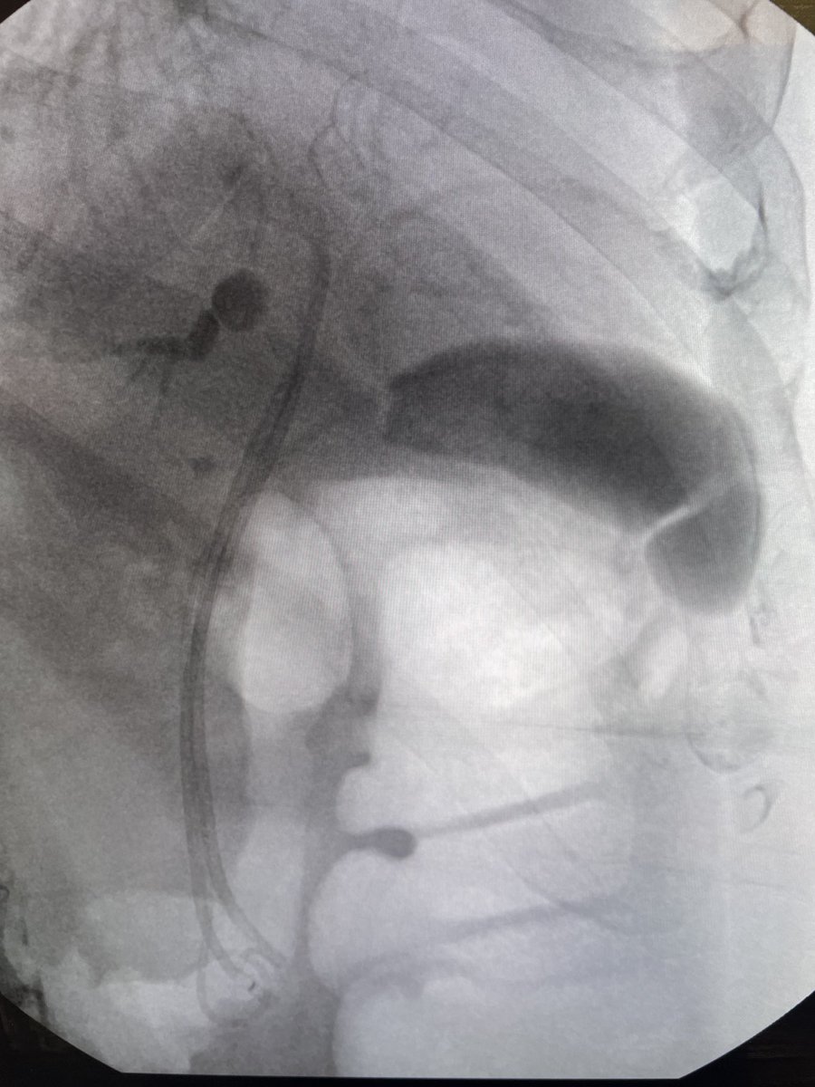 DouglasAdlerMD's tweet image. Suspected cholangiocarcinoma with cholecystitis. Two biliary stents placed across the hilum, one double pigtail stent placed into the gallbladder. #gitwitter #surgery