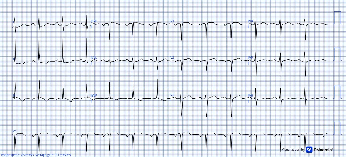 TheECGMedic's tweet image. 57M with CP for 2days

What do you think of the ECG? 

#ECG #ECGChallenge
