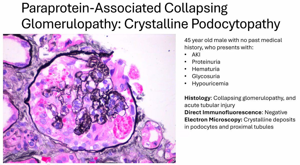 Unusual cause of collapsing glomerulopathy - light chain crystalline podocytopathy.
From Dr. Kelly Smith at <a href="/GlomCon/">GlomCon</a>