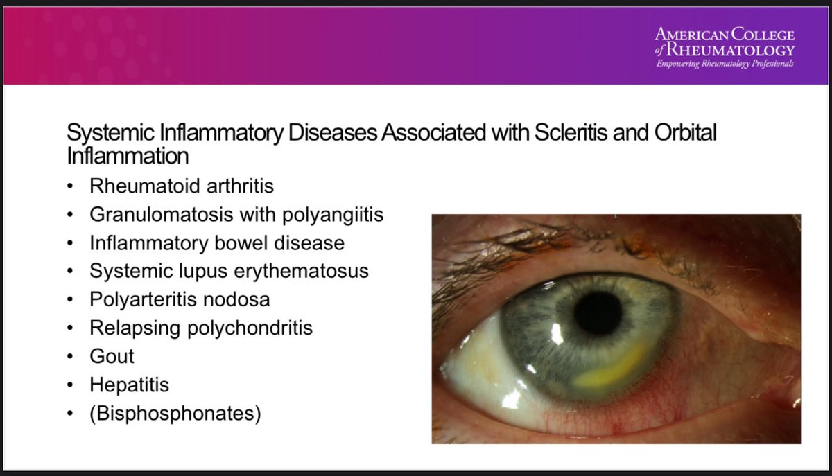 dr_immuno29's tweet photo. 🧠 Blast from the Past | #ACR25
Laura J. Kopplin, MD, PhD | Univ of Wisconsin–Madison
“Inflammatory Eye Disease: Diagnosis & Treatment Strategies”

👁️ When the eye tells the story of systemic inflammation…

→ Anterior: SpA, JIA, TINU
→ Intermediate: MS, Sarcoid
→ Posterior/Panuveitis: SLE, Behçet, VKH

💊 Advance beyond drops when:
• Bilateral / recurrent disease
• CME / posterior synechiae
• Steroid responder or >2× drops daily
• Pediatric cases

💉 Therapy pearls:
MTX ≈ MMF (FAST Trial)
Adalimumab = only FDA-approved non-steroid (VISUAL I–III)
Tocilizumab → refractory CME
Rituximab → scleritis/orbital inflammation

👁️ Think beyond topical—control inflammation, preserve vision.

#ACR25 #RheumTwitter #ACRambassador #Uveitis #Scleritis #InflammatoryEyeDisease #BlastFromThePast