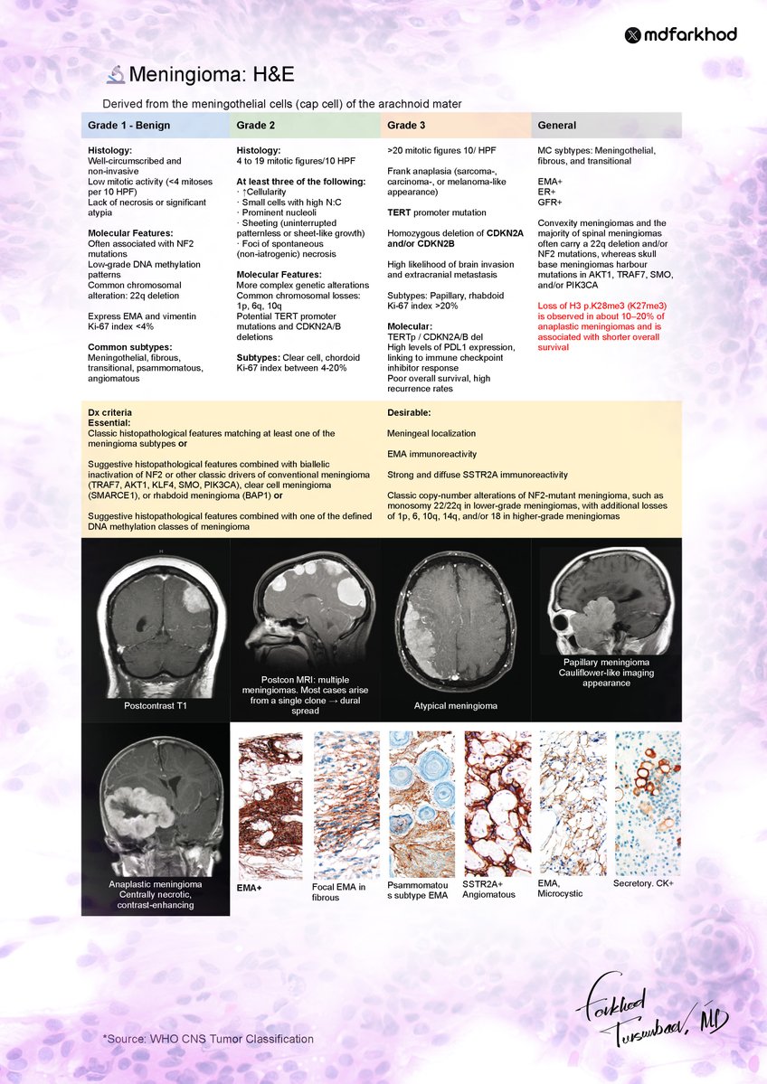 mdfarkhod's tweet photo. 🧠Meningioma histology at a glance — condensed from the WHO CNS Tumor Classification.
Educational summary for residents and trainees: histology, molecular features, key IHC, and radiology examples. 
 Source: WHO CNS Classification 
#Pathology #Neuropathology #Meningioma #UTMB https://t.co/ssbqBdyW50