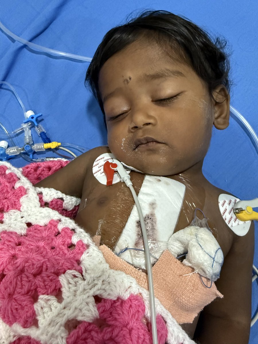 Conclusion of Healing Little Hearts ♥️ Liv’s Legacy 🐙 camp 4, Karimnagar, India 🇮🇳 13 open heart surgeries, 70 out patients, echos, CT scans and angiograms all done free of cost for the desperate children and parents. Amazing team work by volunteers and multi disciplinary local