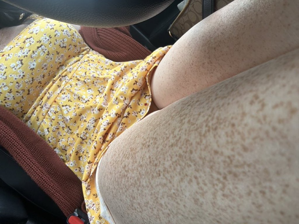 noranick602's tweet photo. Freckles baby 🧡🤍💍 https://t.co/t92wXIk7FF
