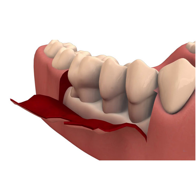 If you’ve been told you have “bone loss” by your dentist, this can be accelerated by your pre-existing state of bone health. People with osteoporosis are going to have a worse time. 

You can’t reverse it, and you can’t really do a bone graft for it when the loss of bone shifts