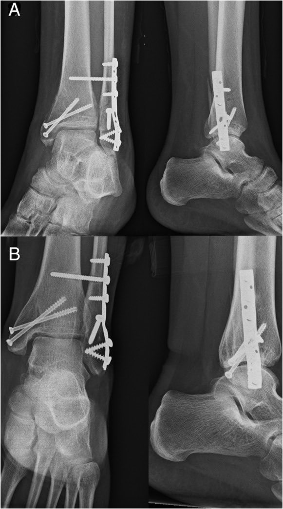 DrJesseMorse's tweet image. Cam Skattebo 

Suffered a right ankle (tibia, fibula) fracture dislocation today.

There are reports that he is undergoing surgery today in Philadelphia. 

This is most likely because he suffered what is known as an open fracture, meaning that the bone popped through the skin.…