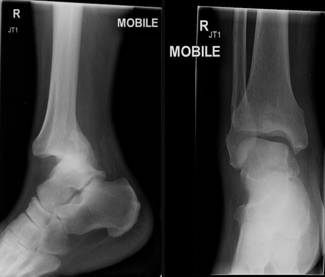DrJesseMorse's tweet image. Cam Skattebo 

Suffered a right ankle (tibia, fibula) fracture dislocation today.

There are reports that he is undergoing surgery today in Philadelphia. 

This is most likely because he suffered what is known as an open fracture, meaning that the bone popped through the skin.…