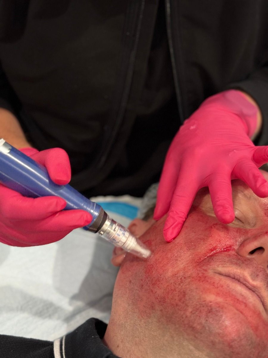 🧛♀️ Vampire Facial Season is Here 🩸✨
Microneedling + PRP (Platelet-Rich Plasma) uses your body’s own growth factors to enhance healing, boost collagen, and improve skin texture, tone, and elasticity.

👉 Book your Vampire Facial today at buff.ly/FzxZrW3.