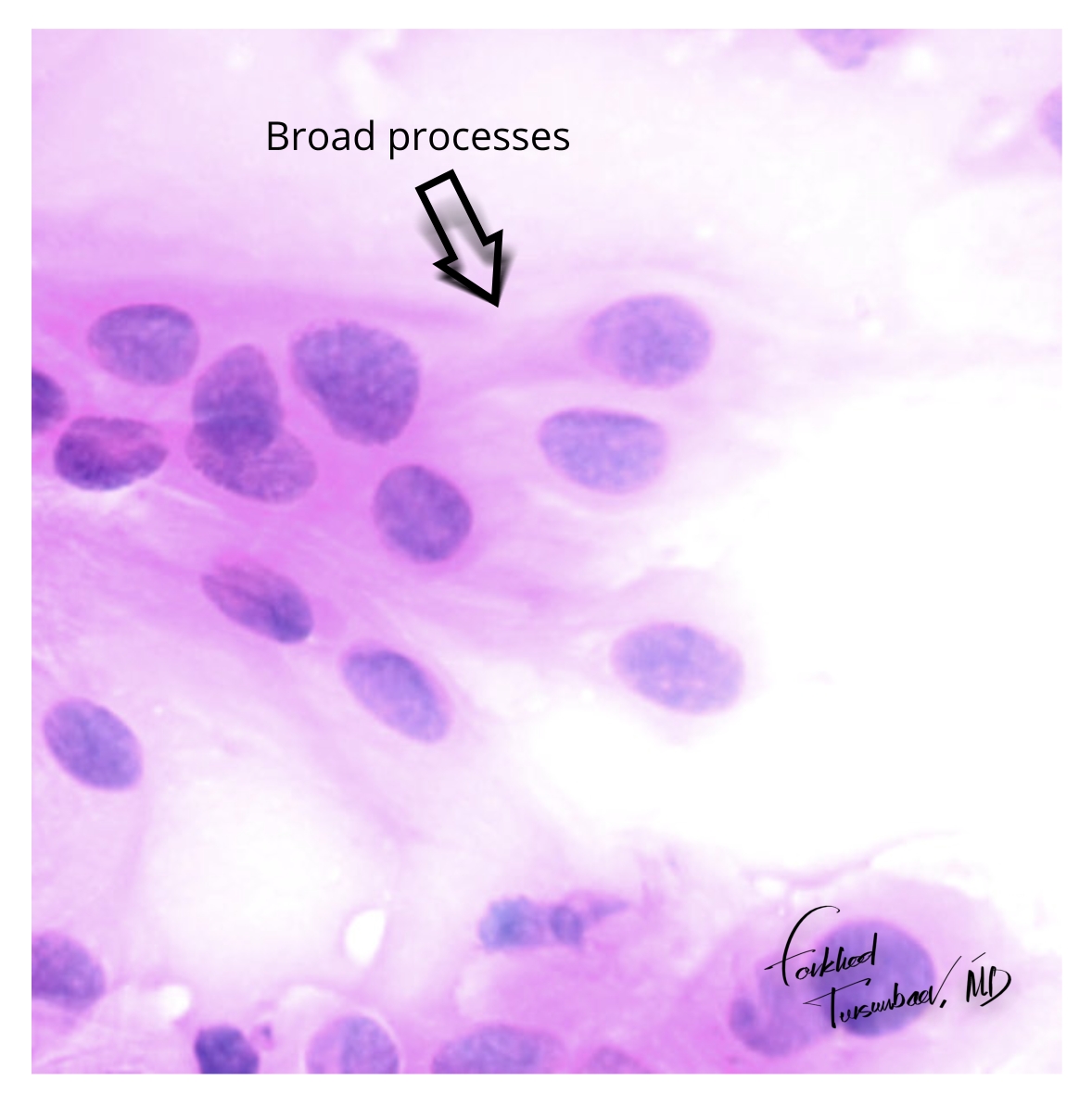 mdfarkhod's tweet photo. 🔬 Meningioma, smear prep (H&amp;E)

Classic cytologic features:
➡️ Monotonous meningothelial cells
➡️ Syncytial pattern with indistinct borders
➡️ Whorls and broad cytoplasmic processes

#Pathology #Cytology #Neuropathology #PathTwitter https://t.co/eEccjjRbOi