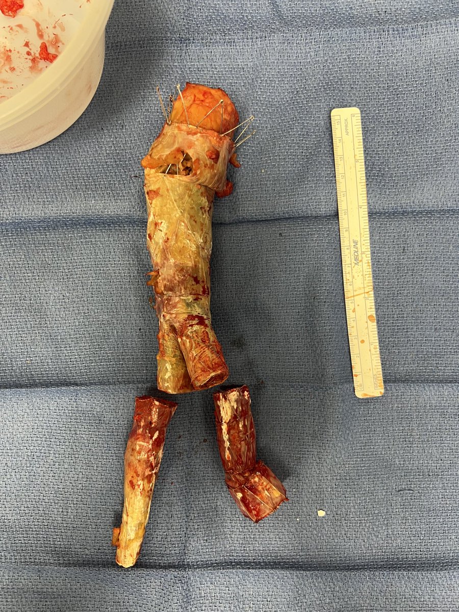 MCWVascSurg's tweet photo. In the last week - graft explants, IVC tumor resection/reconstruction, ALIFs, PMEGs, TAMBEs, dialysis access, and so much more - great job by the whole team including faculty, fellows, APPs, nurses, techs, and many others!  Team work makes the dream work ⁦⁦@MCWSurgery⁩ https://t.co/L24eAnuB0T