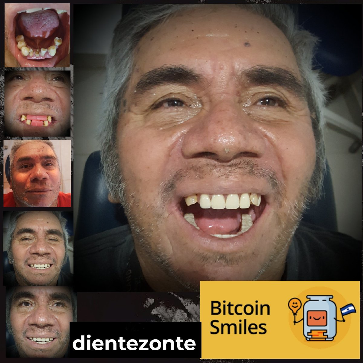 We performed 14 extractions and treated him with periodontal + antibiotic therapy. After several months of bone healing and gum relief, we restored his smile with a wonderful set of dentures thanks to BTC 🦷🦷🦷🦷🏆😀💛🇸🇻