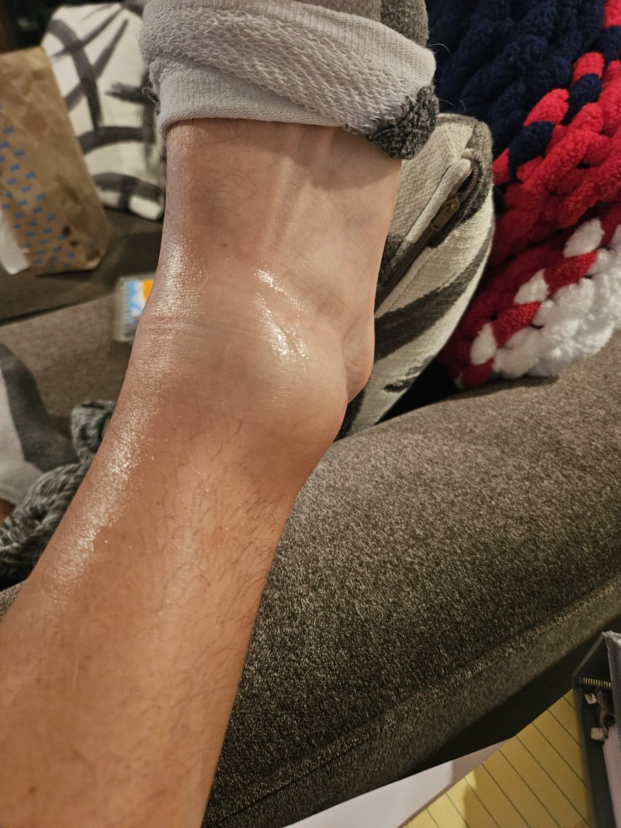 LanceBordewick's tweet photo. Began using DMSO based on your series (thank you, stuffs amazing), but recently had a particularly severe high ankle sprain. I own a small biz where i am very physcially active and cant really just miss weeks to heal up. It fortunately happened right at the end of my day, so i was able to go right home and apply dmso. I let it absorb, dried, then followed the rice protocol. 
By day 2, the ankle was swollen several inches in diameter and walking was extremely painful, so just rested all day. I applied DMSO 99.9% gel all around the inflamed areas 2-3 times a day, along with a gel i had purchased of bpc-157 w/dmso.
By day 3 the swelling was starting to sudside already and i could walk with moderate pain. At that point the fluid had built up around the toes and was freely swishing around. This is normal as the swelling aubsides but the fluid from the injury and swelling hasnt yet been cleared. This point was reached almost a week sooner than i ever had in the past.
By day 4 i was in very minimal pain and back to being able to work with a brace on. There was a tightness in the injured area, but i was already able to bend it to some degree without risk of pain or reinjuring.
A week in a was fully back to work and had a slight re-roll on the injured ankle in a corrugated floor trailer, but it didnt hurt or reinjure at all.
2 weeks out and the ankle brace was off. Some tightness still remained and most mobility was back and completely pain free. I used no other pain relievers or treatments during this time. I also discontinued daily applications at this point. 
Ive had about half a dozen fairly serious ankle sprains in my life, so im very familiar with the healing time and this was astonishingly quick. Thank you so much for writing these. Im attempting to responsibly spread the word. Ill include pics from the first xouple of days.