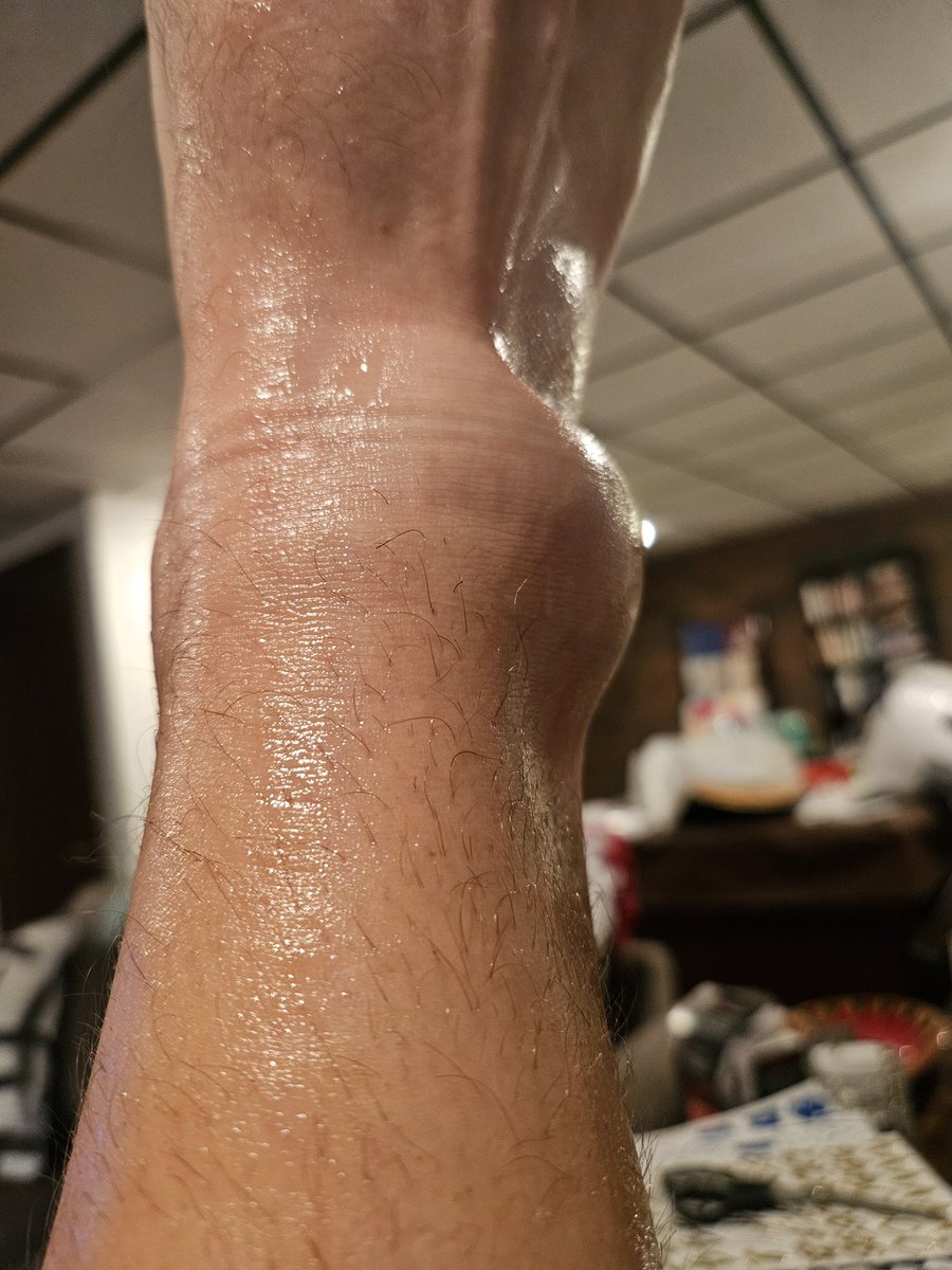 LanceBordewick's tweet photo. Began using DMSO based on your series (thank you, stuffs amazing), but recently had a particularly severe high ankle sprain. I own a small biz where i am very physcially active and cant really just miss weeks to heal up. It fortunately happened right at the end of my day, so i was able to go right home and apply dmso. I let it absorb, dried, then followed the rice protocol. 
By day 2, the ankle was swollen several inches in diameter and walking was extremely painful, so just rested all day. I applied DMSO 99.9% gel all around the inflamed areas 2-3 times a day, along with a gel i had purchased of bpc-157 w/dmso.
By day 3 the swelling was starting to sudside already and i could walk with moderate pain. At that point the fluid had built up around the toes and was freely swishing around. This is normal as the swelling aubsides but the fluid from the injury and swelling hasnt yet been cleared. This point was reached almost a week sooner than i ever had in the past.
By day 4 i was in very minimal pain and back to being able to work with a brace on. There was a tightness in the injured area, but i was already able to bend it to some degree without risk of pain or reinjuring.
A week in a was fully back to work and had a slight re-roll on the injured ankle in a corrugated floor trailer, but it didnt hurt or reinjure at all.
2 weeks out and the ankle brace was off. Some tightness still remained and most mobility was back and completely pain free. I used no other pain relievers or treatments during this time. I also discontinued daily applications at this point. 
Ive had about half a dozen fairly serious ankle sprains in my life, so im very familiar with the healing time and this was astonishingly quick. Thank you so much for writing these. Im attempting to responsibly spread the word. Ill include pics from the first xouple of days.