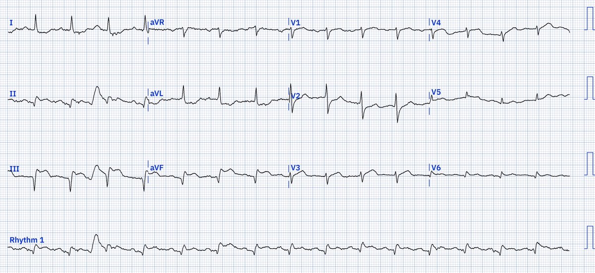 EcgOxford's tweet image. Aphasic patient p/w Diaphoresis
Dx?
@akneton @yolyabreuh @UlhasDr @DidlakeDW @ecgrhythms @IhabFathiSulima @DrPharmDMDTh @Vadeboncoeur_Al @smithECGBlog @EM_RESUS
@estudiomedicina @OrlandoRPN @fxgodzeuss #EPeeps #FOAMcc @ResusMed @TrRja @NaokiThukishima @ecgandrhythmRoe