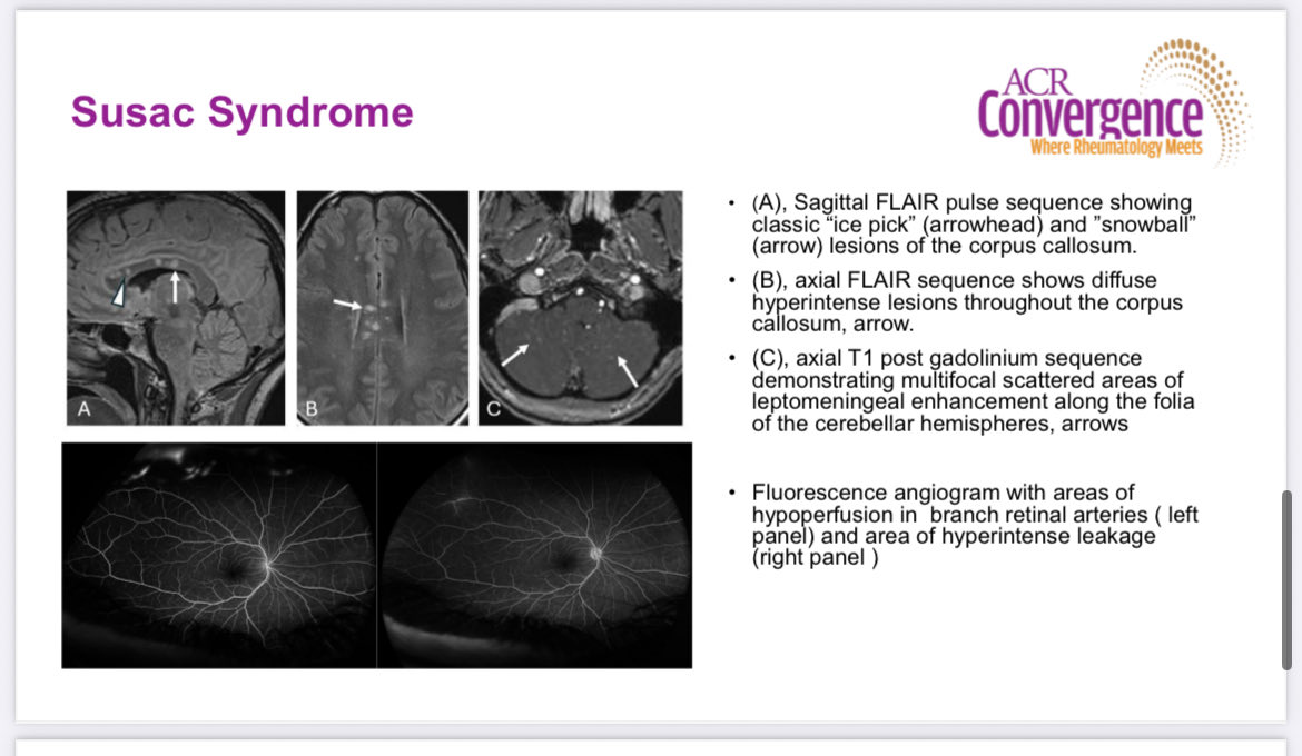 RoxOsler's tweet image. CNS Vasculitis #ACR25 
🔸Susac syndrome: autoimmune microangiopathy mimicking CNS vasculitis.
🔸Triad: encephalopathy, hearing loss, retinal artery occlusion.
🔸MRI: corpus callosum lesions (“ice pick/snowball”).
👉 Mimic, not true vasculitis.