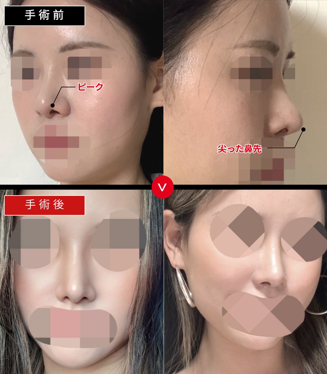 鼻形成術 = Aesthetic Rhinoplasty : 美容外科手術手技 橋口 晋一郎/ 骨切り・鼻整形…フェイスリフト/ 顔フル/ 形成外科