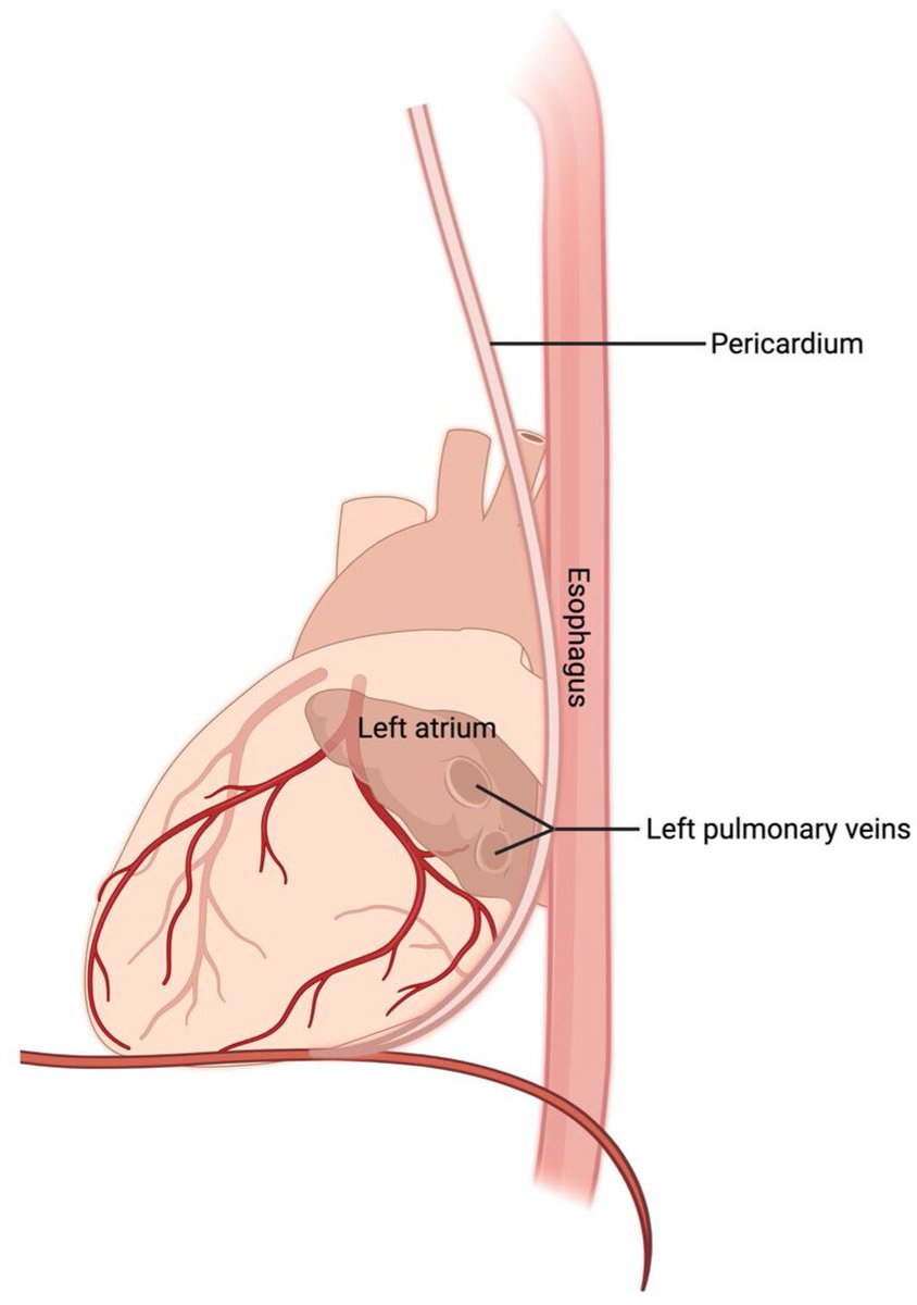 ⚡ Atrioesophageal fistula (AEF) after AF ablation: rare but catastrophic, by <a href="/EmilyRabinovich/">Emily P. Rabinovich, MD, MSc</a> <a href="/LindaMThoracic/">Linda Martin</a> 

📍 Key points:
🔹 Mortality approaches 100% without prompt diagnosis.
🔹 Contrast-enhanced CT is the diagnostic gold standard.
🔹 Underwater endoscopy recommended —