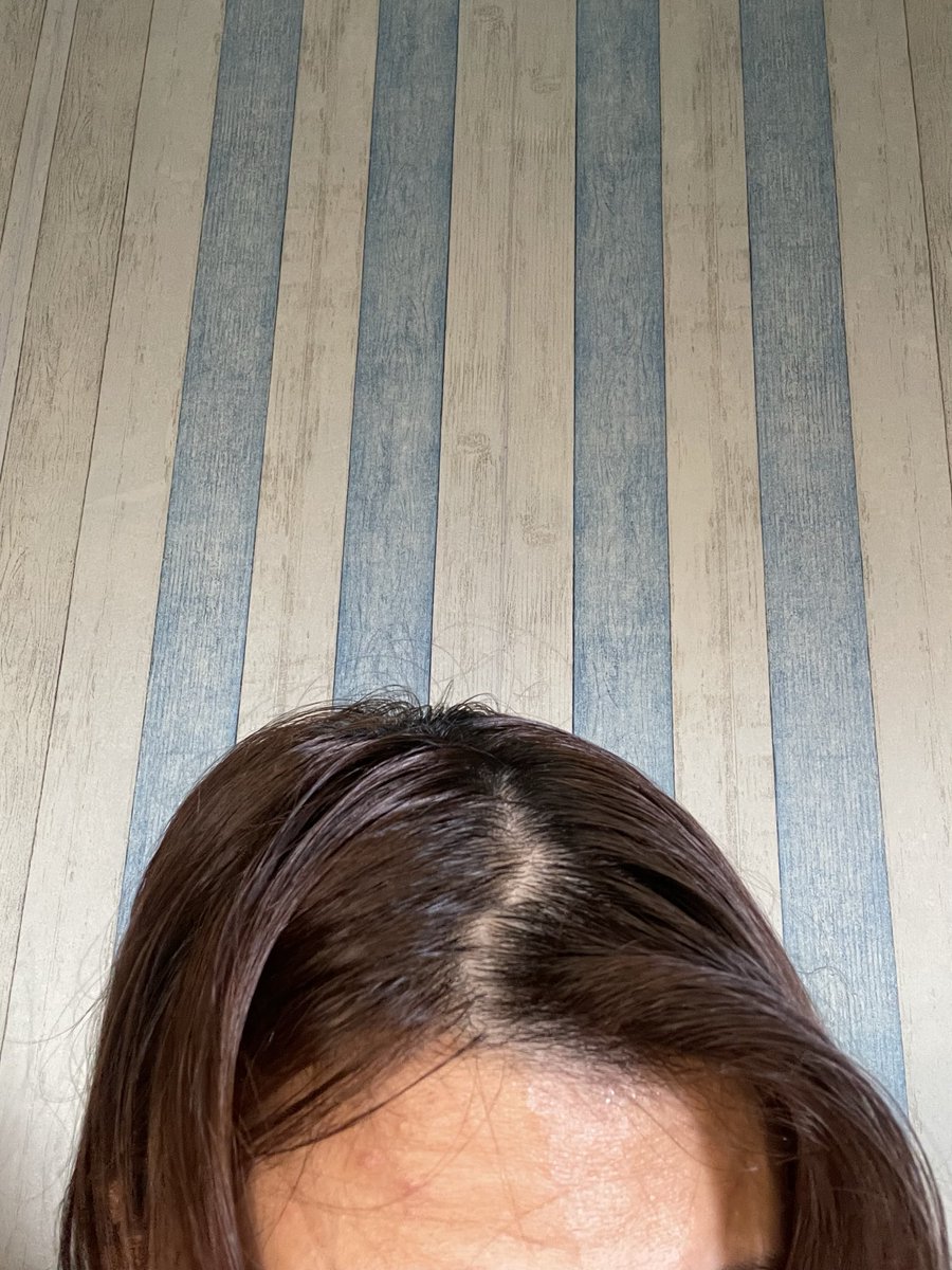 otureii's tweet photo. Awalnya cuma ngira “yaudah, rambut rontok dikit mah wajar.”

Tapi lama-lama kok belah tengah makin lebar, rambut di sisinya makin tipis… Tiap nyisir pasti ada aja helaian yang ikut jatuh😔 https://t.co/XNGS1Nlgxv