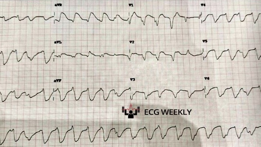 A 30-yo f presents with one hour of chest discomfort and palpitations.  The 12-lead shows a fast rhythm that appears wide at first glance. Cardiology and then EP are consulted and label it VT. Multiple cardioversions and adenosine.... rebrand.ly/hye1940
