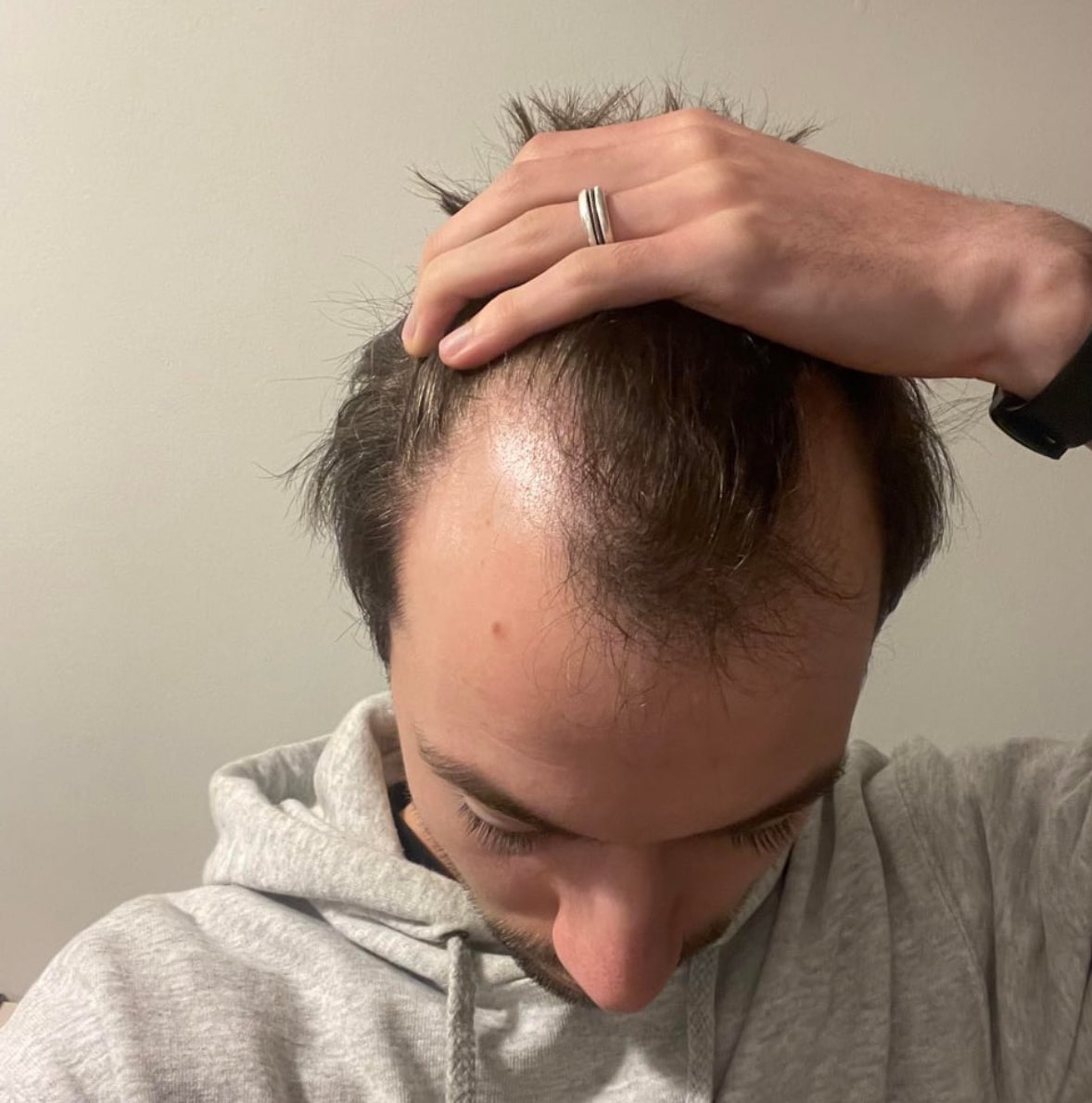UziCryptoo's tweet image. here is my twitter growth strategy:

not a cute girl but i got a receding hairline and i’m only 25 years old