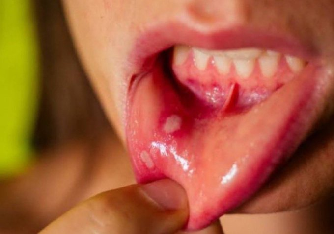Ağızda çıkan beyaz yaraya ne iyi geliyor Allah rızası için söyleyin