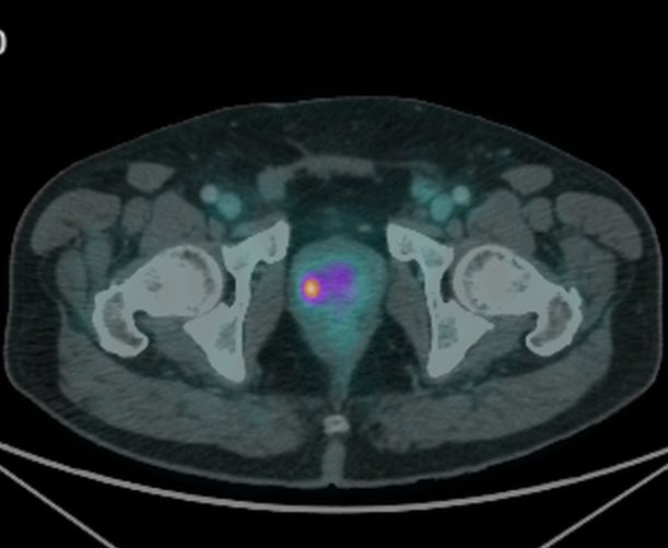 Bruce Rubí HoLEP 🇲🇽 tweet media