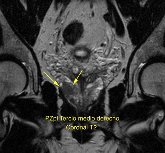 Bruce Rubí HoLEP 🇲🇽 tweet media