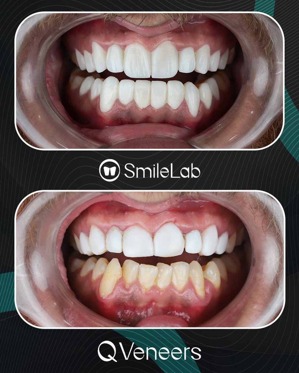 smilewb_jo's tweet image. 🦷 الفرق دايمًا بيبدأ بخطوة صغيرة!
ترتيب بسيط للأسنان ممكن يغيّر شكل ابتسامتك وثقتك بنفسك ✨

مع Smile Lab، النتائج محسوبة بدقة… لتوصلك لابتسامة متناسقة وطبيعية 

#SmileLab #BeforeAfter #DentalCare #SmileTransformation