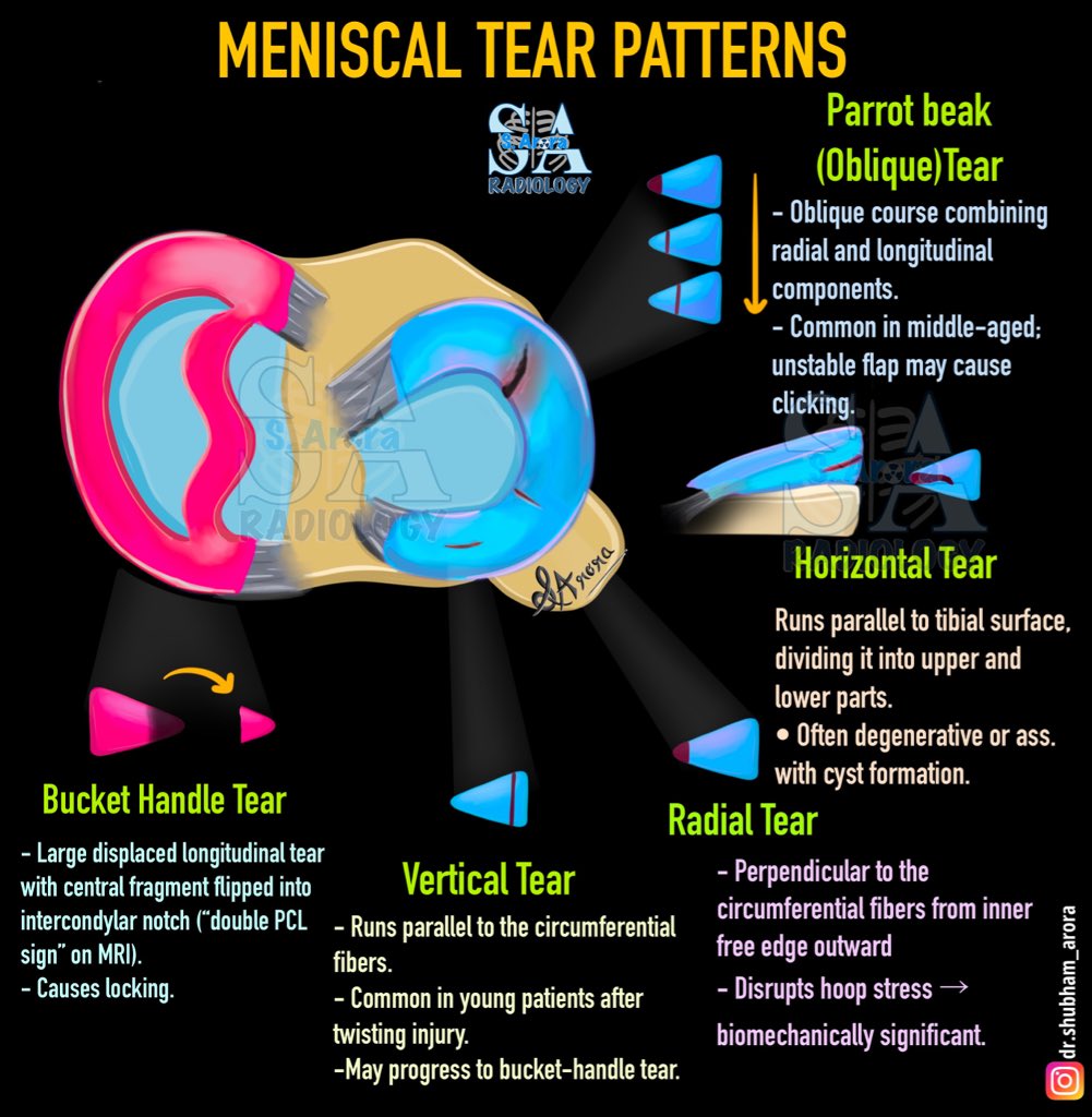 Dr_S_Arora's tweet image. Slide on meniscal tear patterns with silent features. 

#FOAMed #Radiology