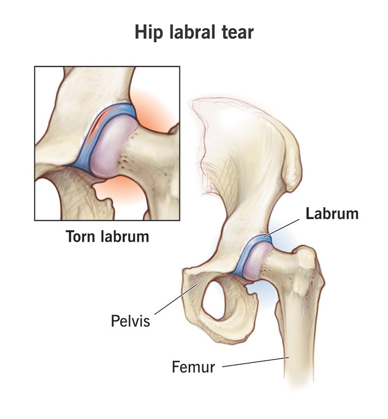 MedEd_Cases's tweet photo. The FADIR or flexion adduction internal rotation test evaluates the piriformis and acetabular labrum among other hip structures. The examiner passively flexes the hip to 90°, then adducts and internally rotates it. A positive result is indicated by pain along the piriformis muscle distribution, radiating sciatic nerve pain down the leg or anterior thigh pain. Sensitivity for FAI and labral tear was 94-99% in one study!

Read: https://t.co/5GJV7tQ5gV

Watch: https://t.co/B8jPWWmZMg

#SportsMedicine #Orthopedics #PhysicalTherapy #AthleticTraining #Rehab #InjuryPrevention #Physio #SportsInjury #SportsRehab #PhysioTherapy #Meded #FOAMed