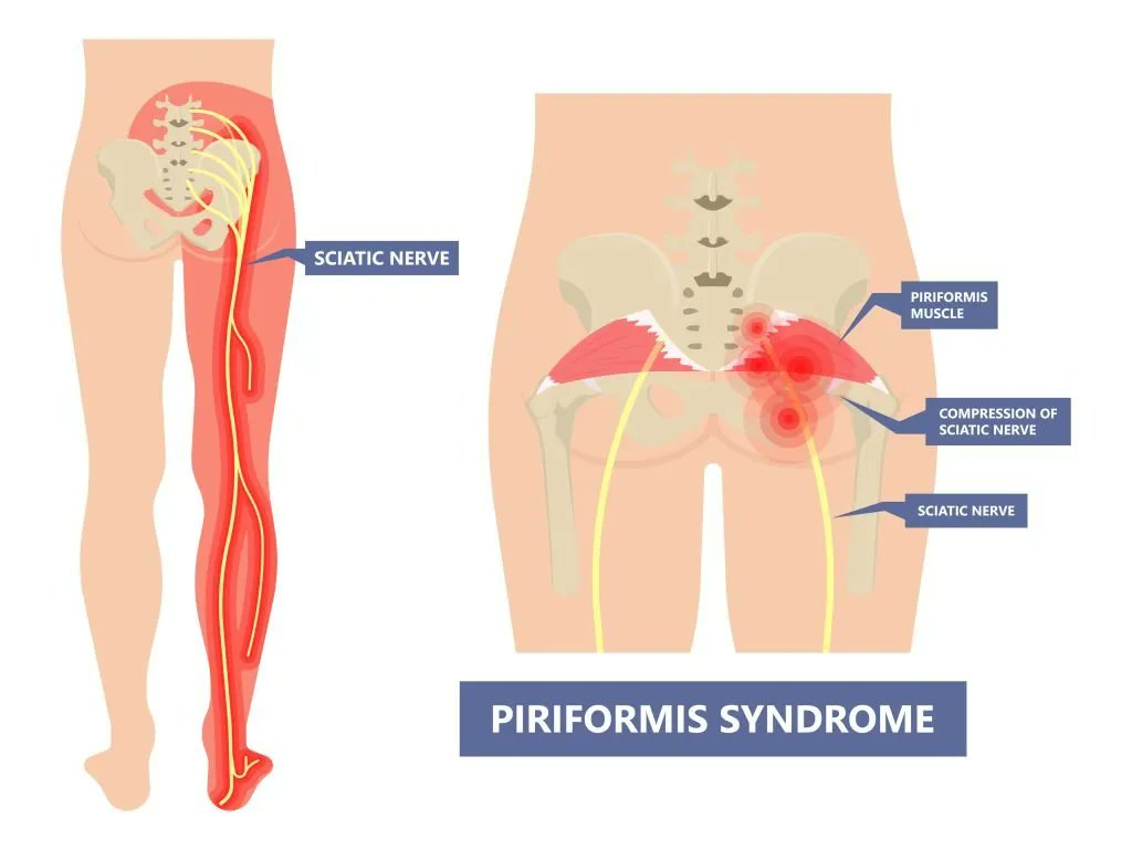 MedEd_Cases's tweet photo. The FADIR or flexion adduction internal rotation test evaluates the piriformis and acetabular labrum among other hip structures. The examiner passively flexes the hip to 90°, then adducts and internally rotates it. A positive result is indicated by pain along the piriformis muscle distribution, radiating sciatic nerve pain down the leg or anterior thigh pain. Sensitivity for FAI and labral tear was 94-99% in one study!

Read: https://t.co/5GJV7tQ5gV

Watch: https://t.co/B8jPWWmZMg

#SportsMedicine #Orthopedics #PhysicalTherapy #AthleticTraining #Rehab #InjuryPrevention #Physio #SportsInjury #SportsRehab #PhysioTherapy #Meded #FOAMed