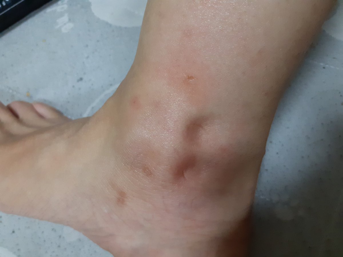 omusubichobimar's tweet photo. この季節なのに虫に刺されて。←また？
くるぶしなくなったー💦😭💦
痒いし痛いし。
毎回何の虫なんだろう？
(汚い足でごめんなさい💦)
#虫刺され https://t.co/pbQfymyzgz