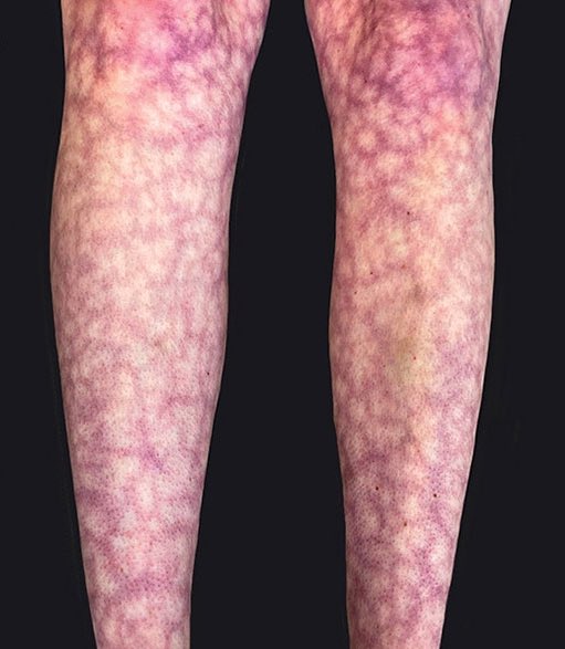 #QuizSEPD Hallazgo en un paciente con pancreatitis aguda. ¿Cuál es el diagnóstico?