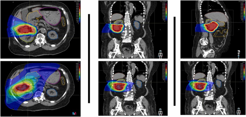theijpt's tweet image. In press now: #kidneycancer represents 4% of all new #Cancer cases in the US. Read a study that suggests #Proton based #SBRT improves target coverage while reducing the dose to primary renal cell carcinoma patient OARs: sciencedirect.com/science/articl…