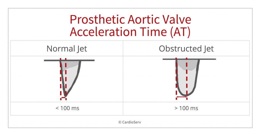 Ahmedata7777's tweet image. Prosthetic Aortic Valve Stenosis Echo assessment 

cardioserv.net/prosthetic-aor…